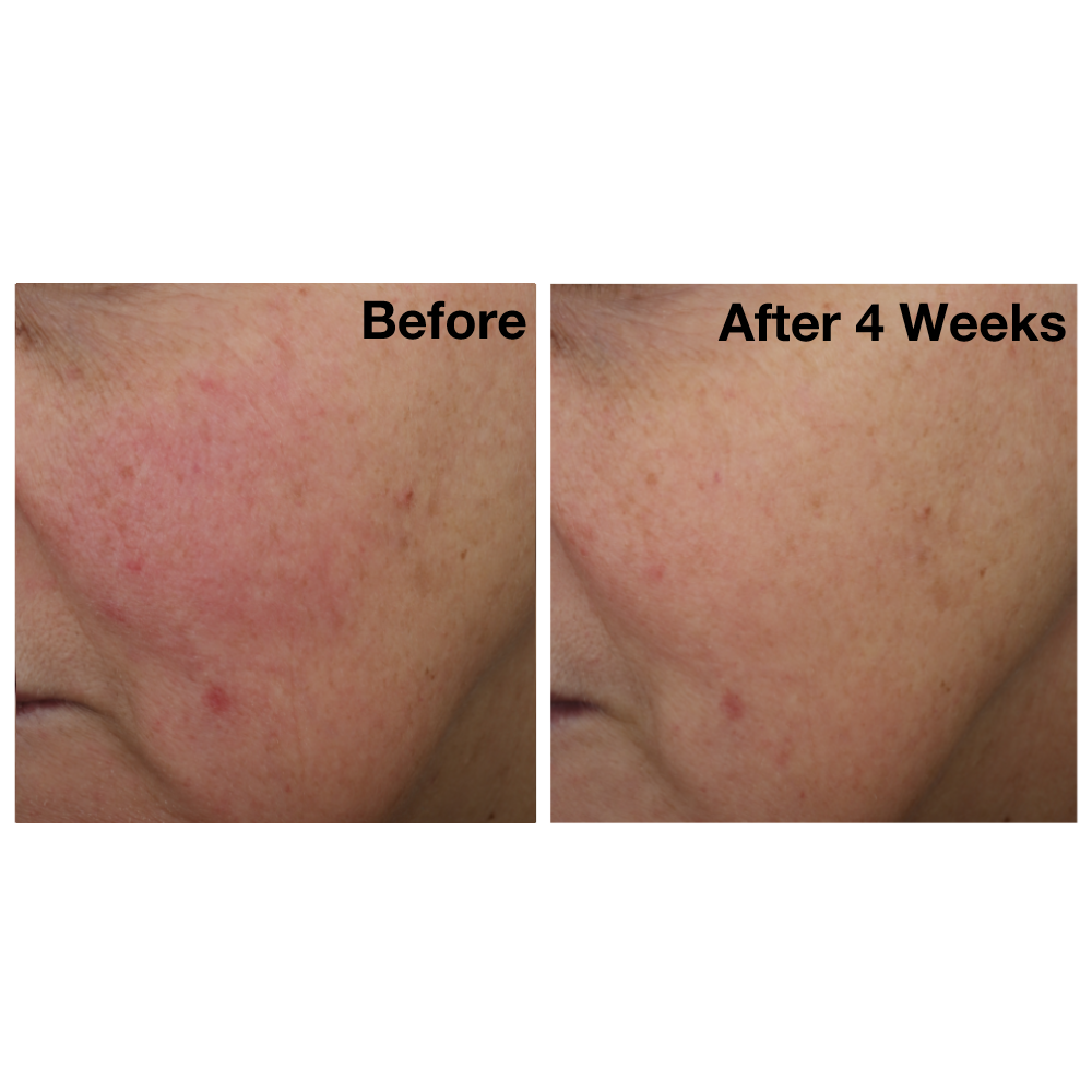Two side-by-side images of a woman&#39;s cheek from The Catalyst clinical trials. Image on the left displays woman&#39;s cheek before using The Catalyst, and the image on the right showsher cheek after using The Catalyst for four weeks.