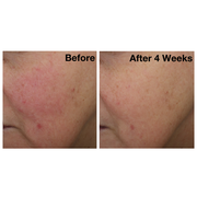 Two side-by-side images of a woman's cheek from The Catalyst clinical trials. Image on the left displays woman's cheek before using The Catalyst, and the image on the right showsher cheek after using The Catalyst for four weeks.