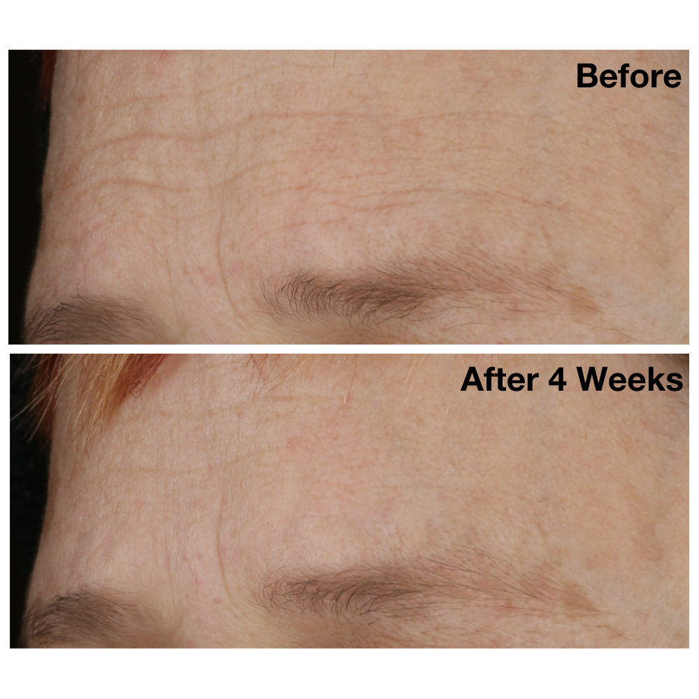 Two images of a woman&#39;s brow from The Catalyst clinical trials. Image on the top displays woman&#39;s brow before using The Catalyst, and the image on the bottom shows her brow after using The Catalyst for four weeks.