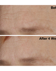 Two images of a woman's brow from The Catalyst clinical trials. Image on the top displays woman's brow before using The Catalyst, and the image on the bottom shows her brow after using The Catalyst for four weeks.