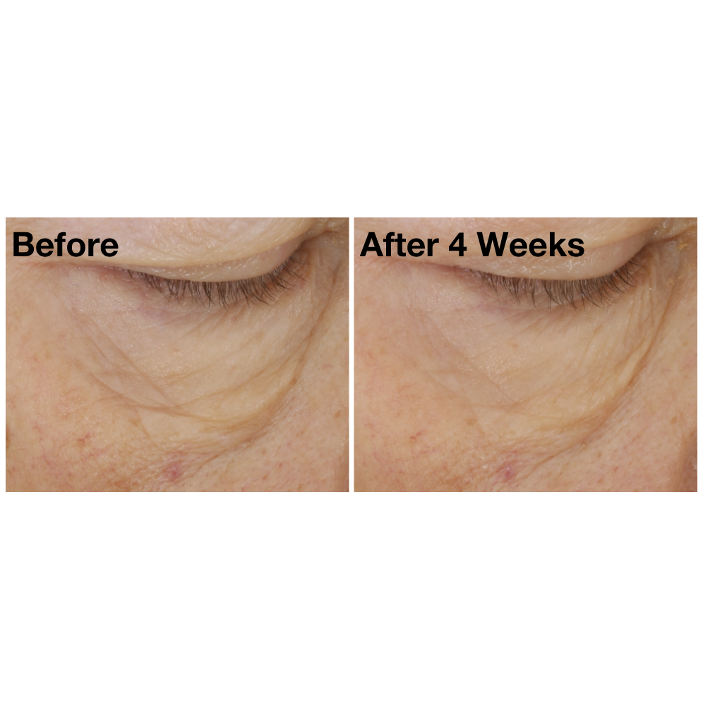 Two images of a woman&#39;s undereye area from The Eye Cure clinical trials. Image on the left displays woman&#39;s undereye area before using The Eye Cure, and the image on the right shows her undereye area after using The Eye Cure for four weeks. 
