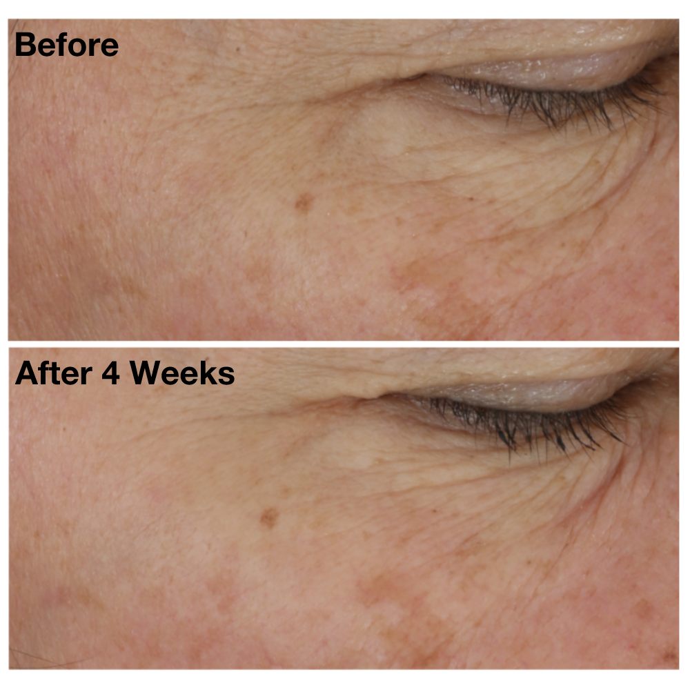 Two images of a woman&#39;s undereye area from The Eye Cure clinical trials. Image on top displays woman&#39;s undereye area before using The Eye Cure, and the image on the bottom shows her undereye area after using The Eye Cure for four weeks. 