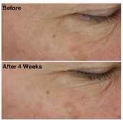 Two images of a woman's undereye area from The Eye Cure clinical trials. Image on top displays woman's undereye area before using The Eye Cure, and the image on the bottom shows her undereye area after using The Eye Cure for four weeks. 