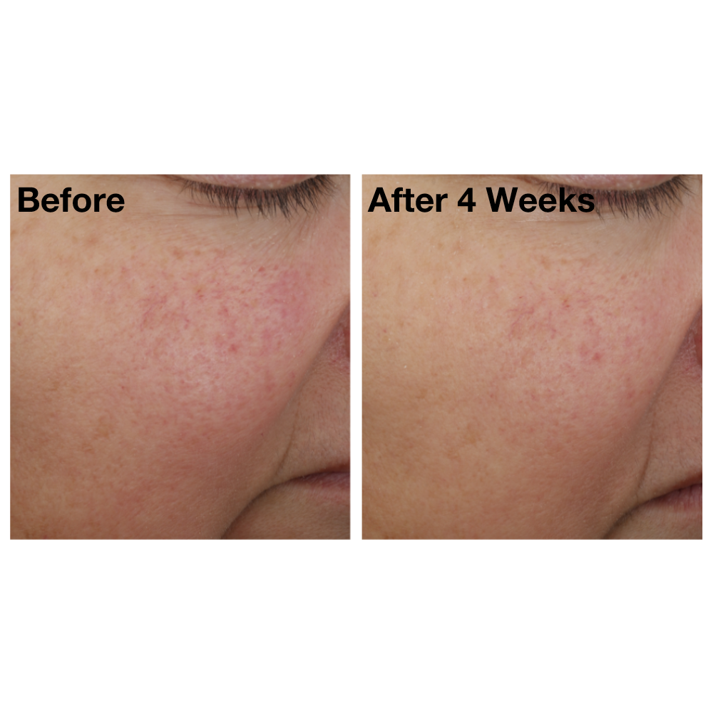 Two side-by-side images of a woman&#39;s cheek from The Night Synthesis clinical trials. Image on the left displays woman&#39;s cheek before using The Night Synthesis, and the image on the right shows her cheek after using The Night Synthesis for four weeks.