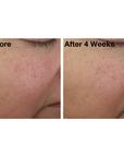 Two side-by-side images of a woman's cheek from The Night Synthesis clinical trials. Image on the left displays woman's cheek before using The Night Synthesis, and the image on the right shows her cheek after using The Night Synthesis for four weeks.