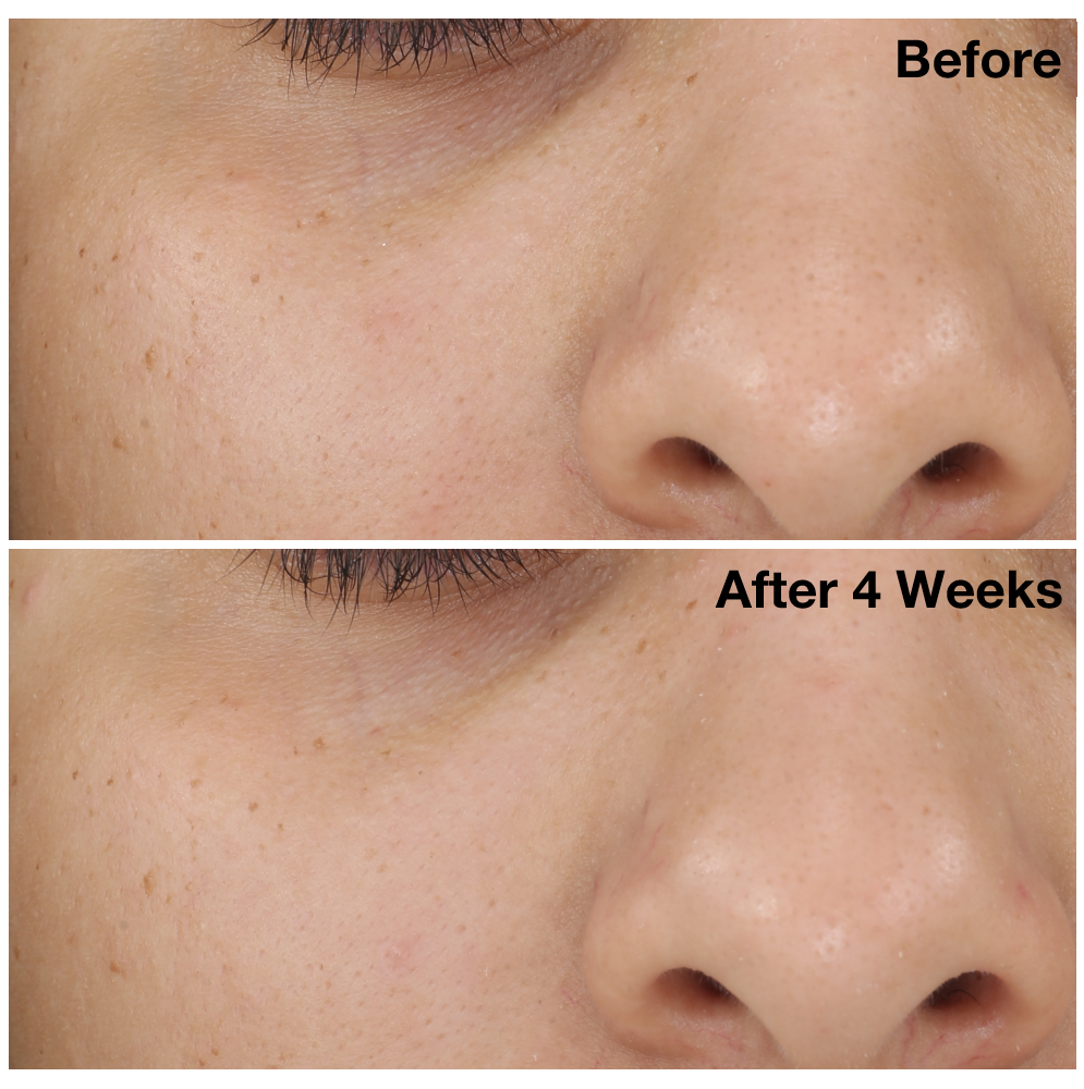 Two images of a woman&#39;s nose and cheek from The Solution clinical trials. Image on the top displays woman&#39;s nose and cheek before using The Solution, and the image on the bottom shows her nose and cheek after using The Solution for four weeks.