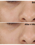 Two images of a woman's nose and cheek from The Solution clinical trials. Image on the top displays woman's nose and cheek before using The Solution, and the image on the bottom shows her nose and cheek after using The Solution for four weeks.