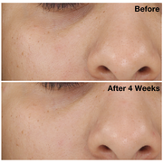 Two images of a woman's nose and cheek from The Solution clinical trials. Image on the top displays woman's nose and cheek before using The Solution, and the image on the bottom shows her nose and cheek after using The Solution for four weeks.